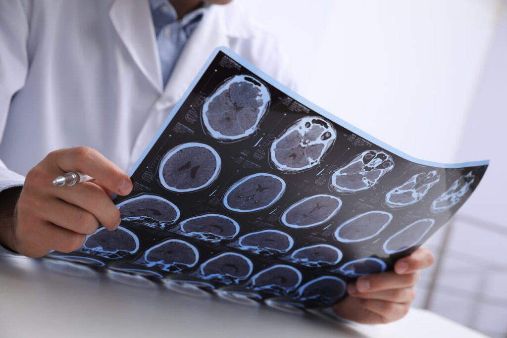 Lesiones Cerebrales Traumáticas