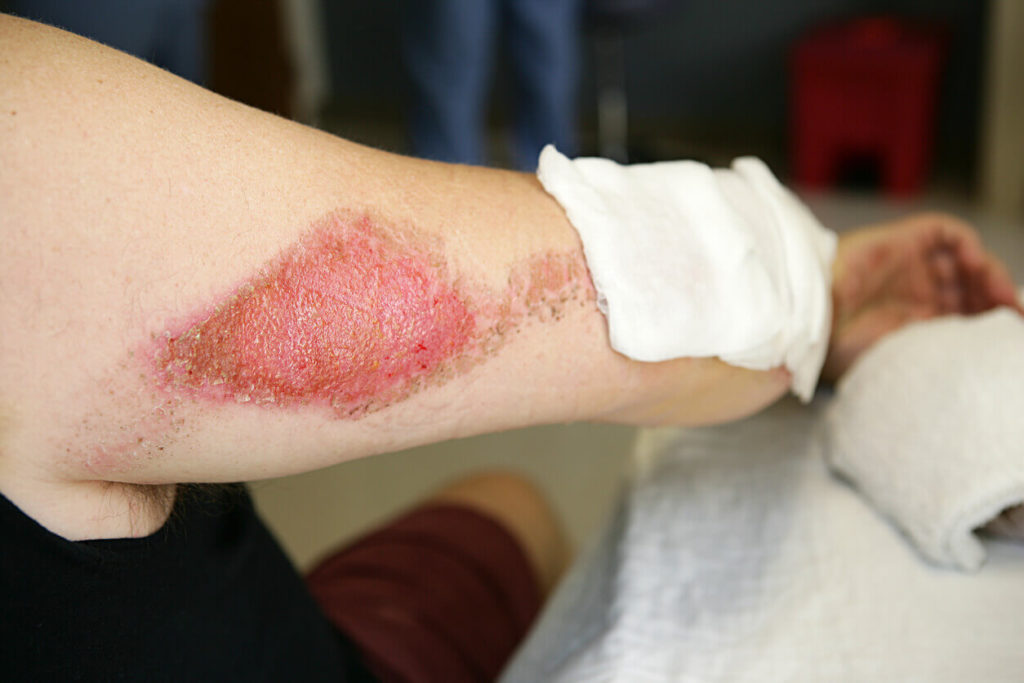 road rash on arm from motorcycle crash