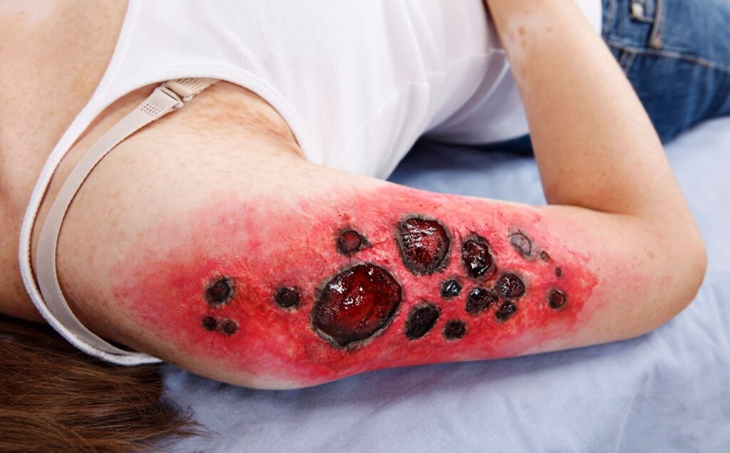 woman laying down with a burn injury on her arm