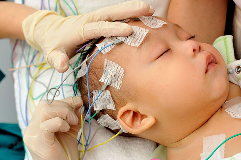 doctors applying electrodes to baby checking for brain injury