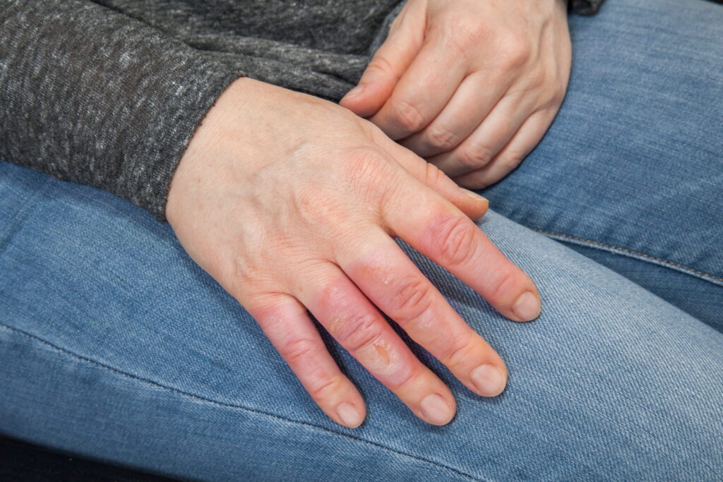 hand of a person resting on their lap with a burn injury